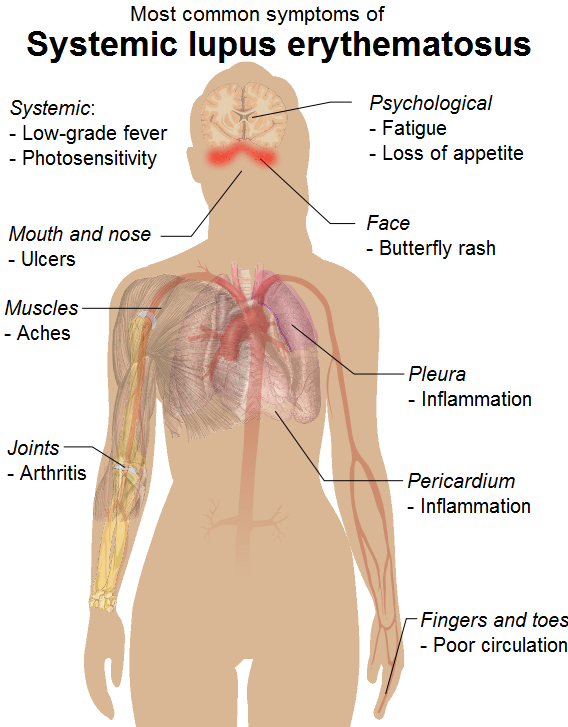 systemic_lupus_erythematosus